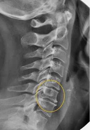 Osteohondroza kralježnice grlića maternice na x -ray